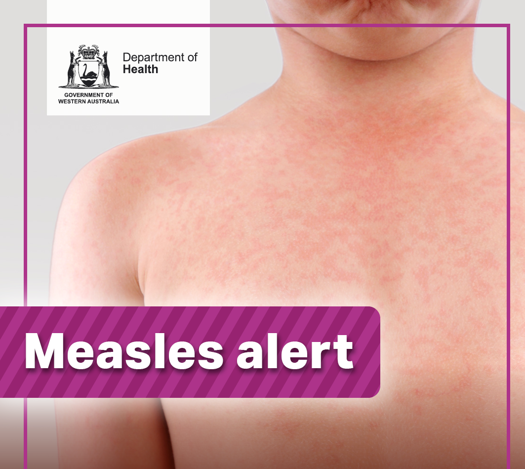 Measles alert