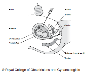 Figure 3: Amniocentesis