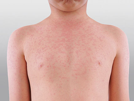 Measles on a child