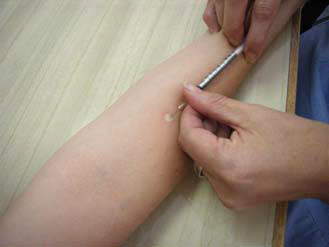 Tuberculin Skin Test being given by injection into forearm